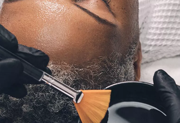 Chemical Peels